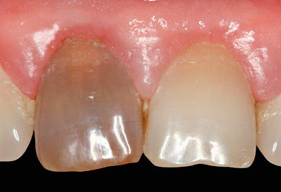 É assim que um dente cuida de algum tempo após o tratamento da pulpite com o uso de pasta de resorcinol-formalina.