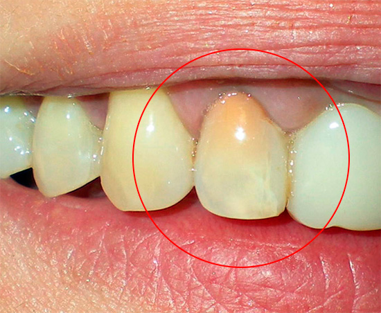 Outro exemplo de dente tratado usando o método de resorcinol-formalina de mumificação da polpa.