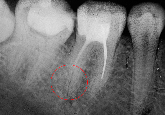 Canal dentário não totalmente selado