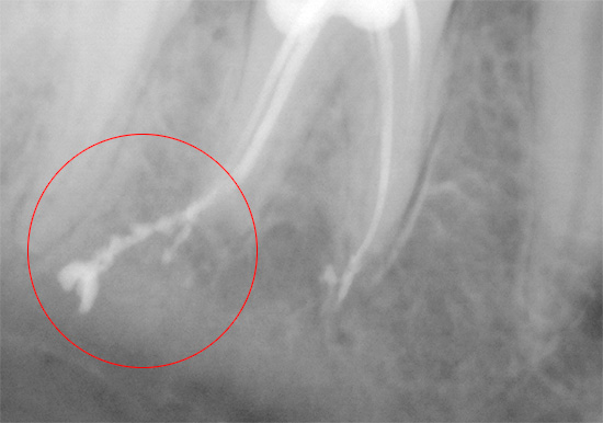 Outro exemplo em que a guta-percha é retirada da raiz de um dente
