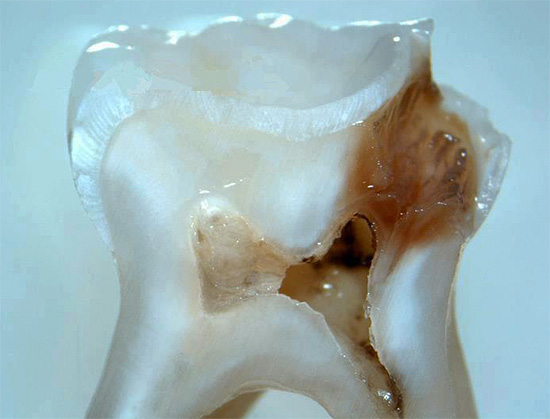 Seção de um dente com uma cárie profunda, com comunicação direta com a câmara pulpar.