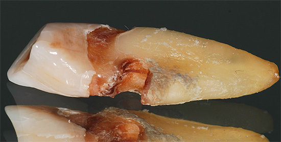 A foto mostra uma profunda cárie na raiz do dente.