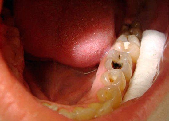Um método diagnóstico importante é a termometria, durante a qual é avaliada a sensibilidade do dente à ação de um irritante da temperatura.