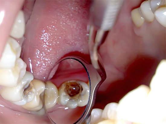 Conosciamo le caratteristiche della pulpite gangrenosa cronica - qual è il pericolo di necrosi della polpa all'interno dei canali radicolari del dente? ..