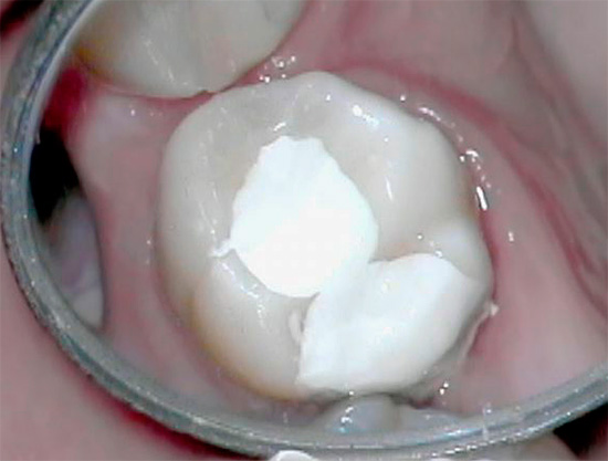 Il posizionamento di pasta devitalizzante sul dente e la successiva chiusura ermetica della cavità con un riempimento temporaneo in caso di pulpite gangrenosa cronica non sono sempre giustificati.
