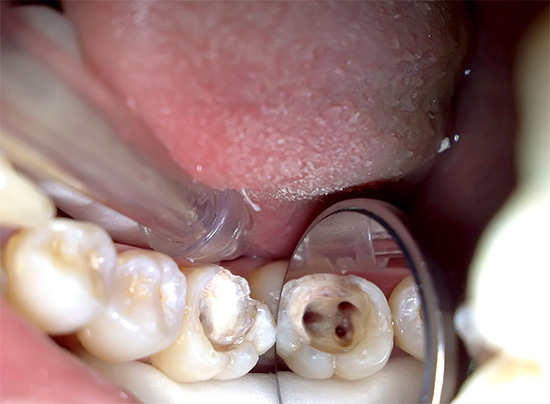 Nella foto, la bocca dei canali radicolari del dente è chiaramente visibile
