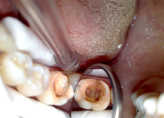 Dopo purificazione e antisettici, i canali vengono riempiti con materiale di riempimento.