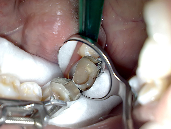 Quindi inizia il restauro dei tessuti persi dal dente.