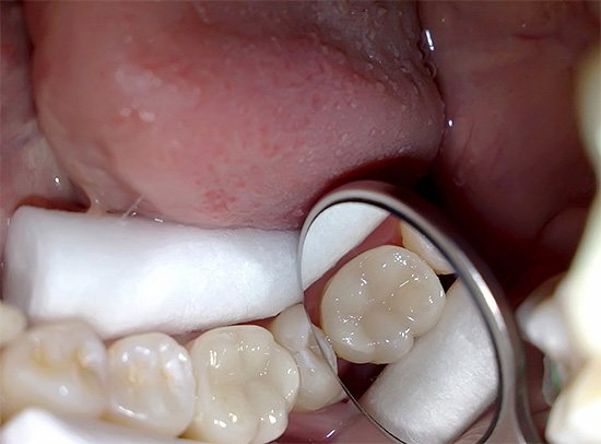 Ed è così che un dente guarda alla fine del trattamento contro la pulpite: non può essere distinto dal vivere.