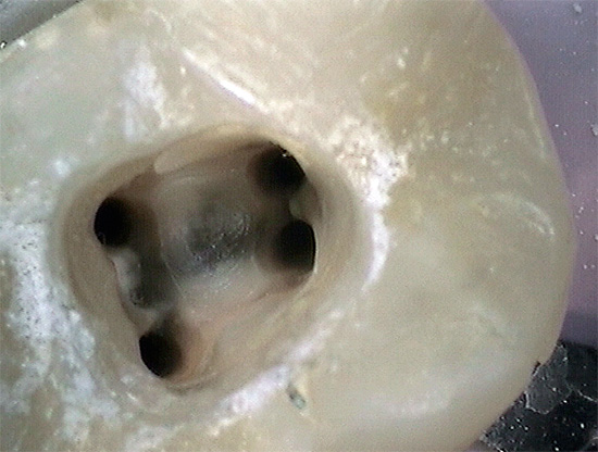 Un passo molto importante nel trattamento della pulpite è l'elaborazione approfondita di ciascun canale radicolare.