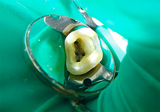 Più canali radicolari in un dente, più costoso sarà il trattamento della pulpite.