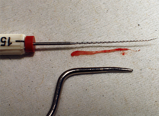 Polpa rimossa dal dente (fascio neurovascolare)