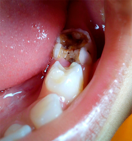 Quando il pus esce dalla camera pulpare, una persona può avvertire una significativa riduzione del dolore, tuttavia, ovviamente, ciò non significa che il dente sia guarito.