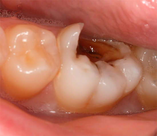 Una caratteristica della pulpite cronica è la lieve sintomatologia, che spesso porta a un trattamento troppo tardi per le cure dentistiche ...