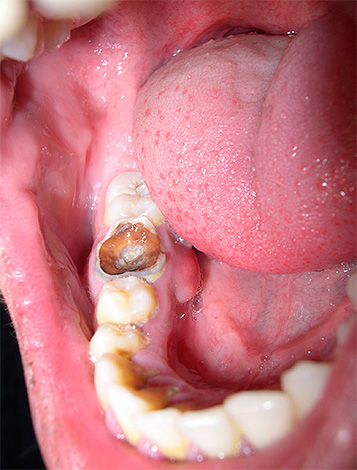 Quando si effettua una diagnosi, un medico riceve una quantità significativa delle informazioni necessarie durante un esame visivo di un dente malato e del suo suono.