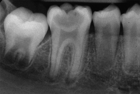 Le immagini radiografiche rivelano patologie nascoste nel dente e nei tessuti circostanti, oltre a valutare la lunghezza e la forma dei canali radicolari.