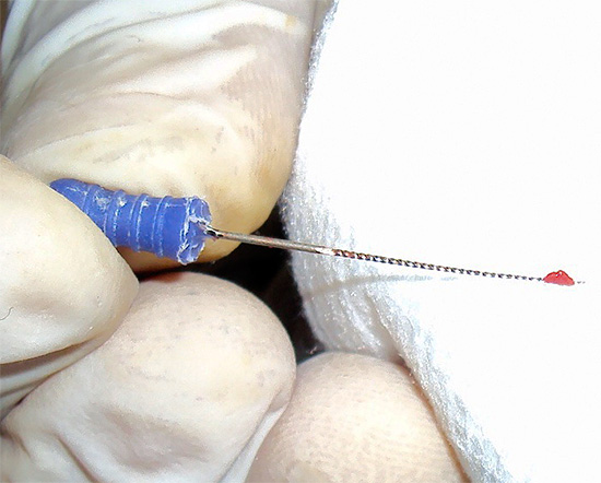 La foto mostra un altro esempio di nervo dentale rimosso.