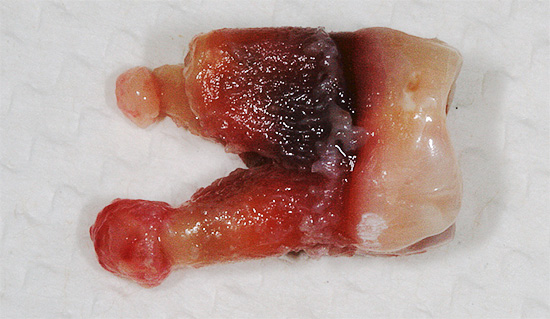La formazione di cisti sulle radici del dente porta spesso alla necessità di rimuoverlo.
