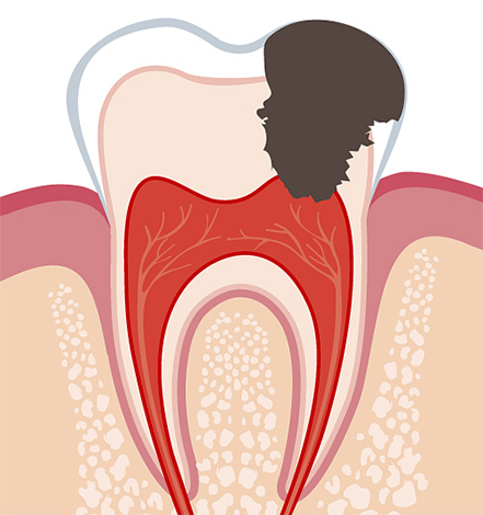 La pulite si sviluppa quando l'infezione arriva al nervo dentale, portando alla sua infiammazione.