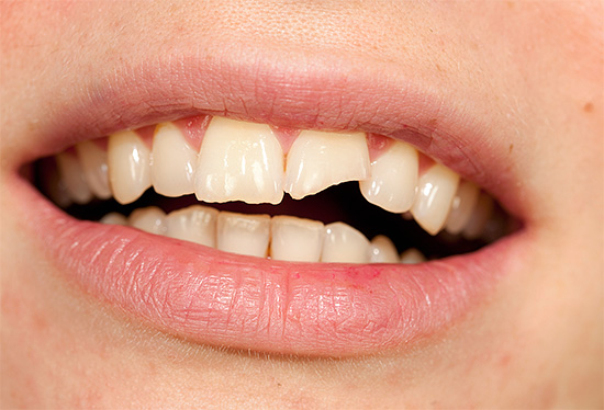 Con un danno meccanico ai denti, può svilupparsi una polpite traumatica.