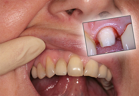 Vamos ver por que às vezes um dente dói sob a coroa e o que pode ser feito nesses casos para aliviar o sofrimento ...