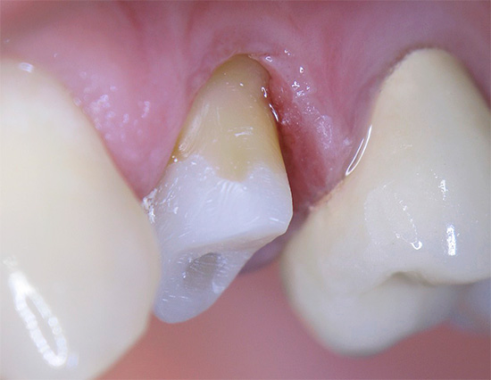 Cada coroa é caracterizada por uma vida útil específica, após a qual o dente embaixo dela pode ficar doente.