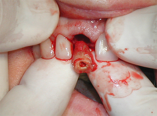 Às vezes, o médico decide remover o dente, se a proteção com a coroa não for mais possível e apropriada.