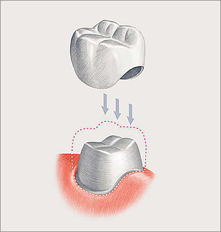 A imagem mostra uma coroa dentária clássica esquematicamente.