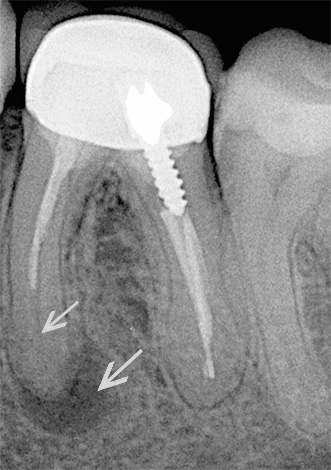 A imagem do dente mostra um canal não completamente preenchido e um granuloma na raiz.