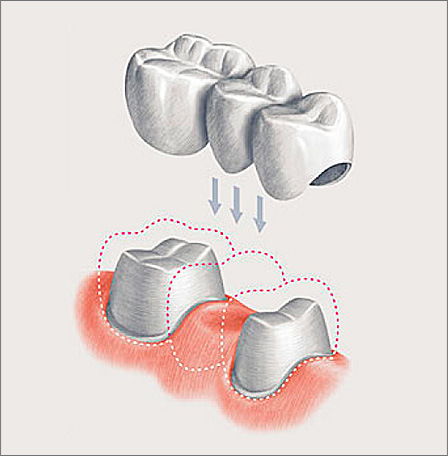 E parece uma ponte - nesse caso, é necessário processar dentes adjacentes sob as coroas