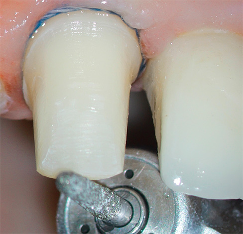 Durante a rotação do dente sob a coroa, ele pode ficar muito quente, o que pode levar à necrose pulpar.