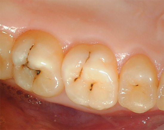 Se você suprime regularmente a dor de dente com pílulas e não vai ao consultório médico, no futuro isso pode levar a problemas muito grandes ...