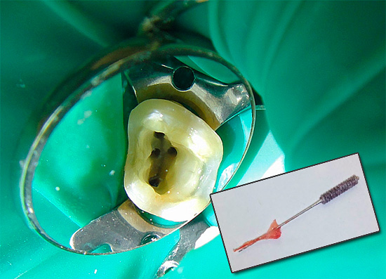 Às vezes, mesmo um dente morto, isto é, depois que um nervo é removido dele, continua a doer muito, e então veremos por que isso acontece e o que fazer em tal situação.