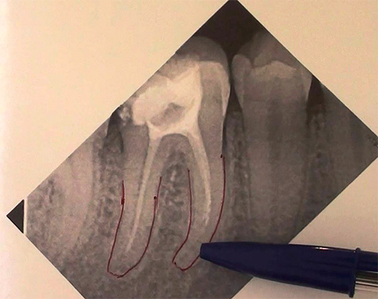Outro raio-X, que mostra que um canal dentário não está selado no ápice da raiz.