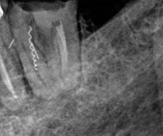 Outro tiro mostrando um pedaço de um instrumento dental preso em um canal.