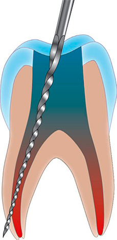 Uma causa comum de dor pós-preenchimento em um dente no qual um nervo é removido é a perfuração da parede do canal radicular.