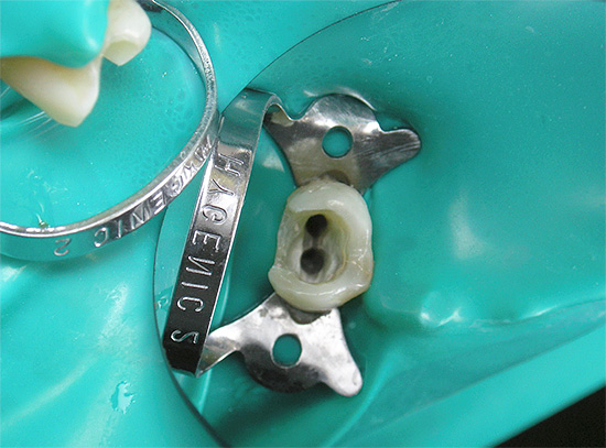 O material de preenchimento com o qual os canais radiculares são preenchidos após a limpeza pode causar uma reação alérgica nos tecidos moles ao redor do dente.