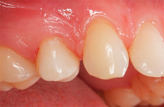 Devido a uma alergia ao material de enchimento, as gengivas próximas a um dente morto podem ser constantemente inflamadas e machucadas.