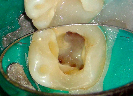 Muitos dentistas acreditam que, após a limpeza dos canais e a instalação dos obturadores, a dor normal no dente pode persistir por mais alguns dias, até uma semana.