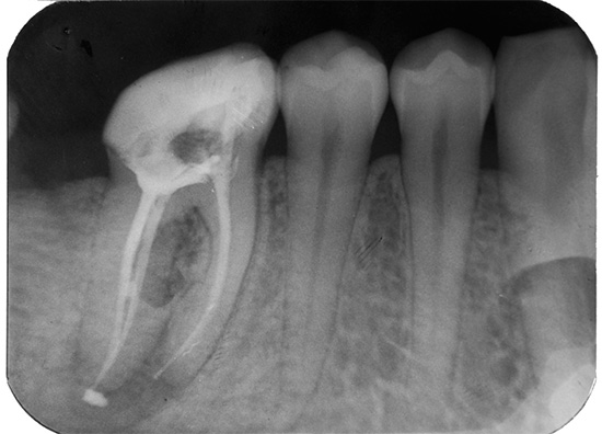 O material extraído além do ápice da raiz pode levar a dores muito longas no dente, até vários meses.