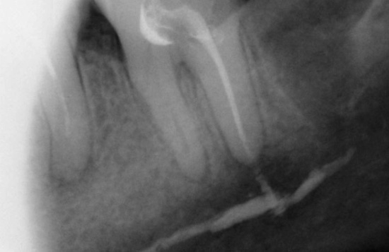 Se a dor persistir por um longo tempo, o dente às vezes é melhor para tratar.