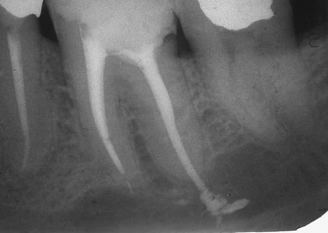 Com a inflamação dos tecidos ao redor do material de enchimento, pode ser doloroso morder um dente e uma pessoa não pode comer normalmente.