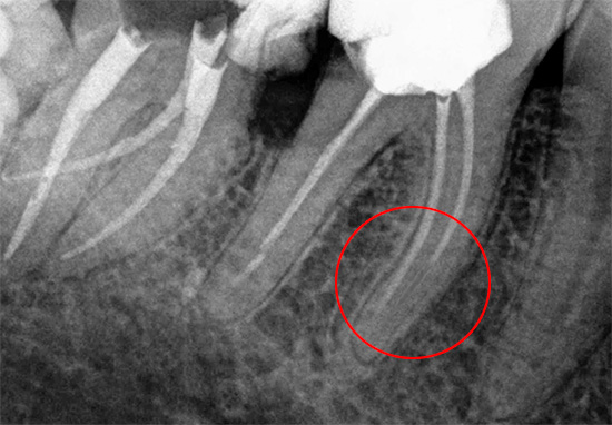Um canal incompletamente selado pode se tornar uma fonte de grandes problemas com o dente no futuro.