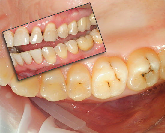I denti possono essere doloranti per una serie di ragioni, quindi cercheremo di capire cosa fare in una determinata situazione per alleviare la sofferenza.