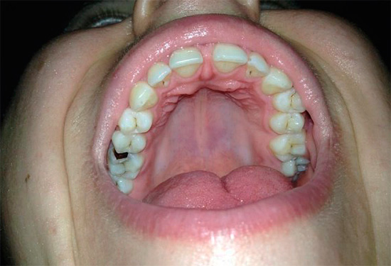 Secondo una delle ricette popolari per alleviare il mal di denti, un pezzo di propoli deve essere collocato in una profonda cavità cariata.