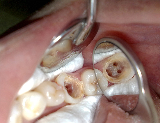I canali radicolari del dente sono chiaramente visibili nella fotografia, ognuno dei quali deve essere accuratamente pulito e sigillato durante il trattamento.