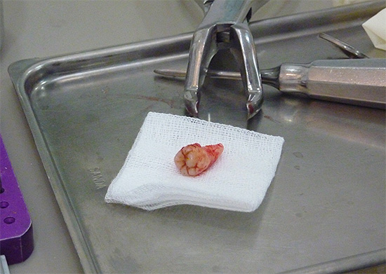 Nella maggior parte dei casi, è meglio rimuovere un dente del giudizio problematico.