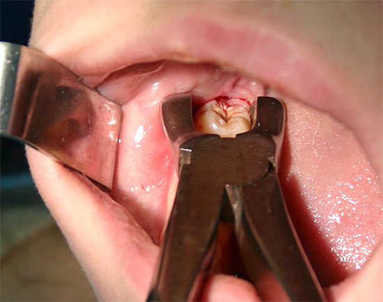 Con i denti del giudizio difficili da dentizione, spesso il modo migliore per sbarazzarsi del dolore e delle possibili complicazioni è rimuoverlo.