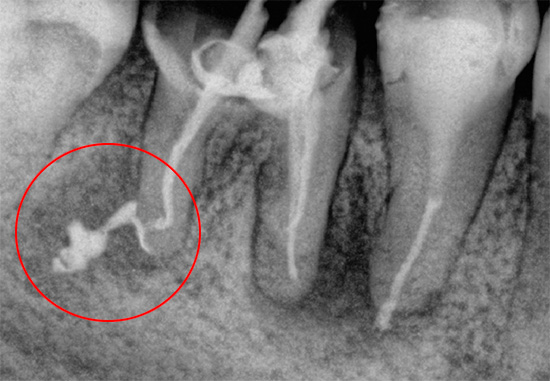 Questa radiografia mostra materiale di riempimento che è stato rimosso al di fuori della radice.