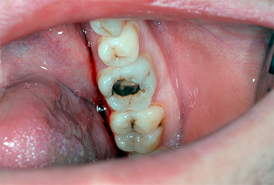 A volte un dente cattivo può persino provocare la sinusite ...